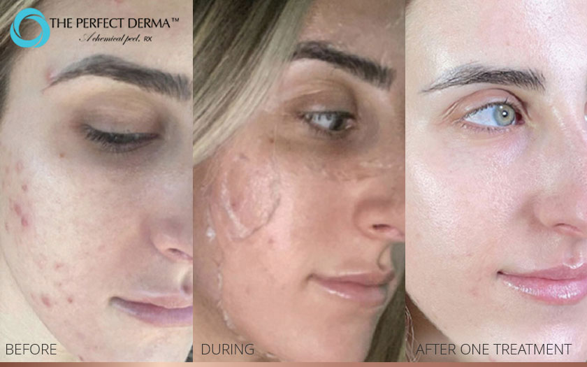 before & after closeup of face -derma peel treatment