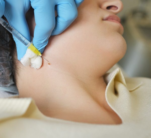 surgeon performs anesthesia before removing a mole or nevus to a female patient in a modern clinic the surgeon performs anesthesia before removing a mole or nevus to a female patient in a modern clinic